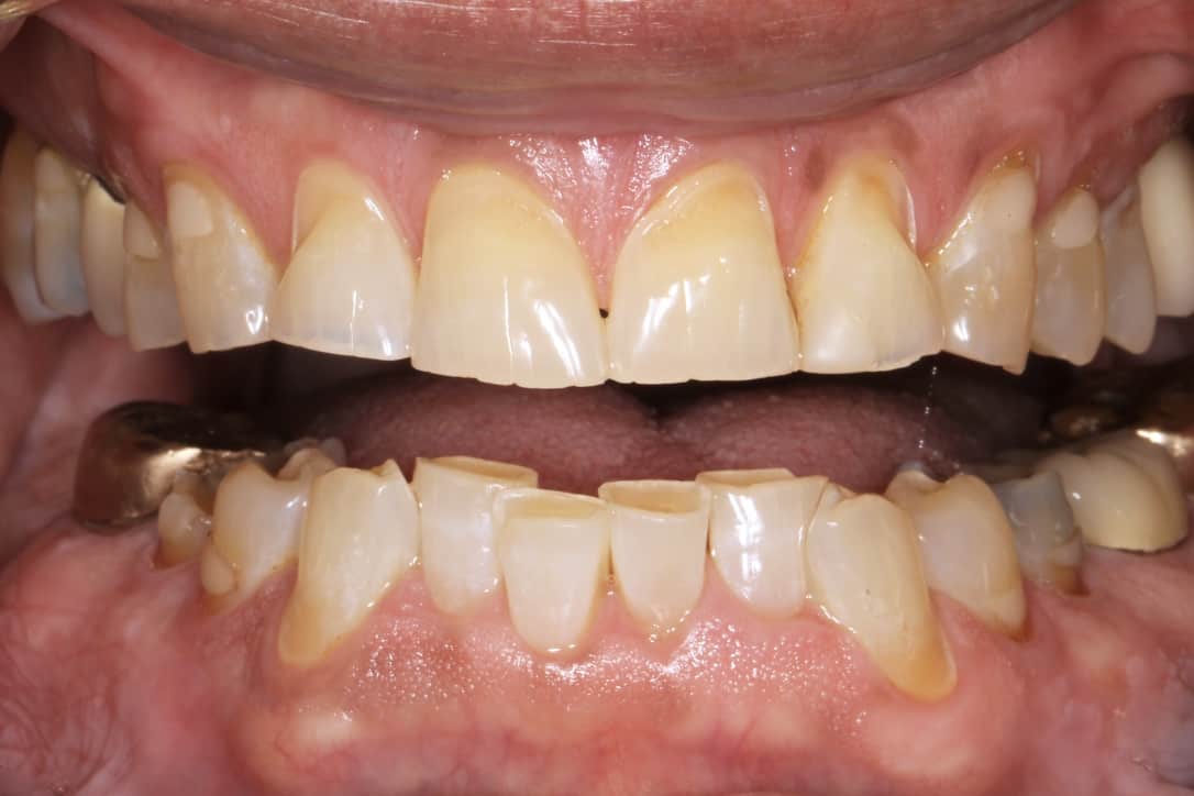 A close-up image of a patient’s damaged teeth