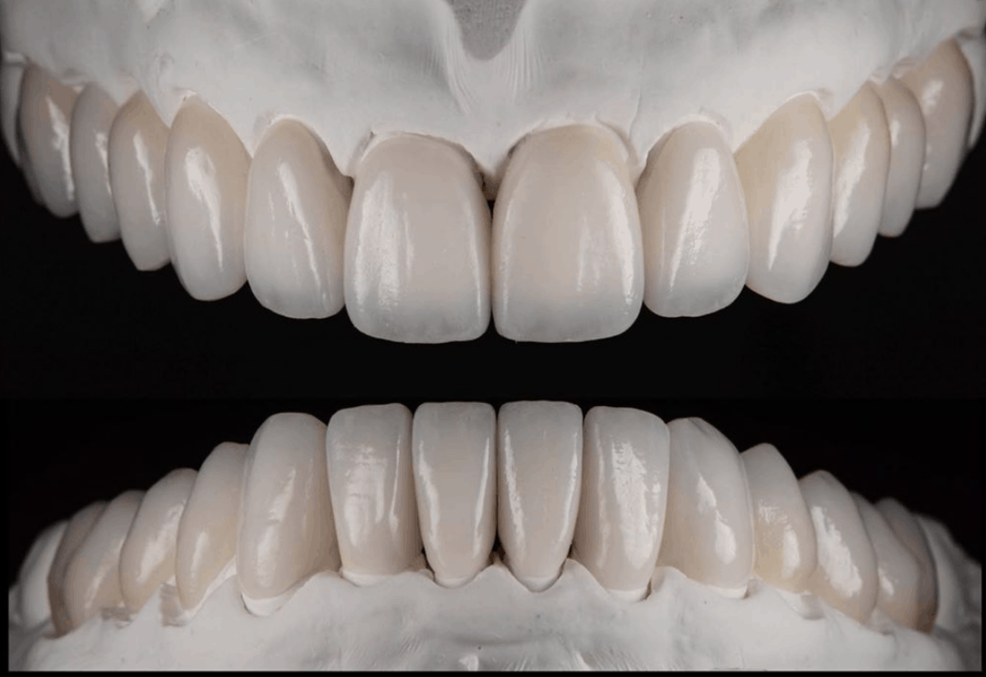 Porcelain Veneers Denver CO Signature Dentistry of Denver