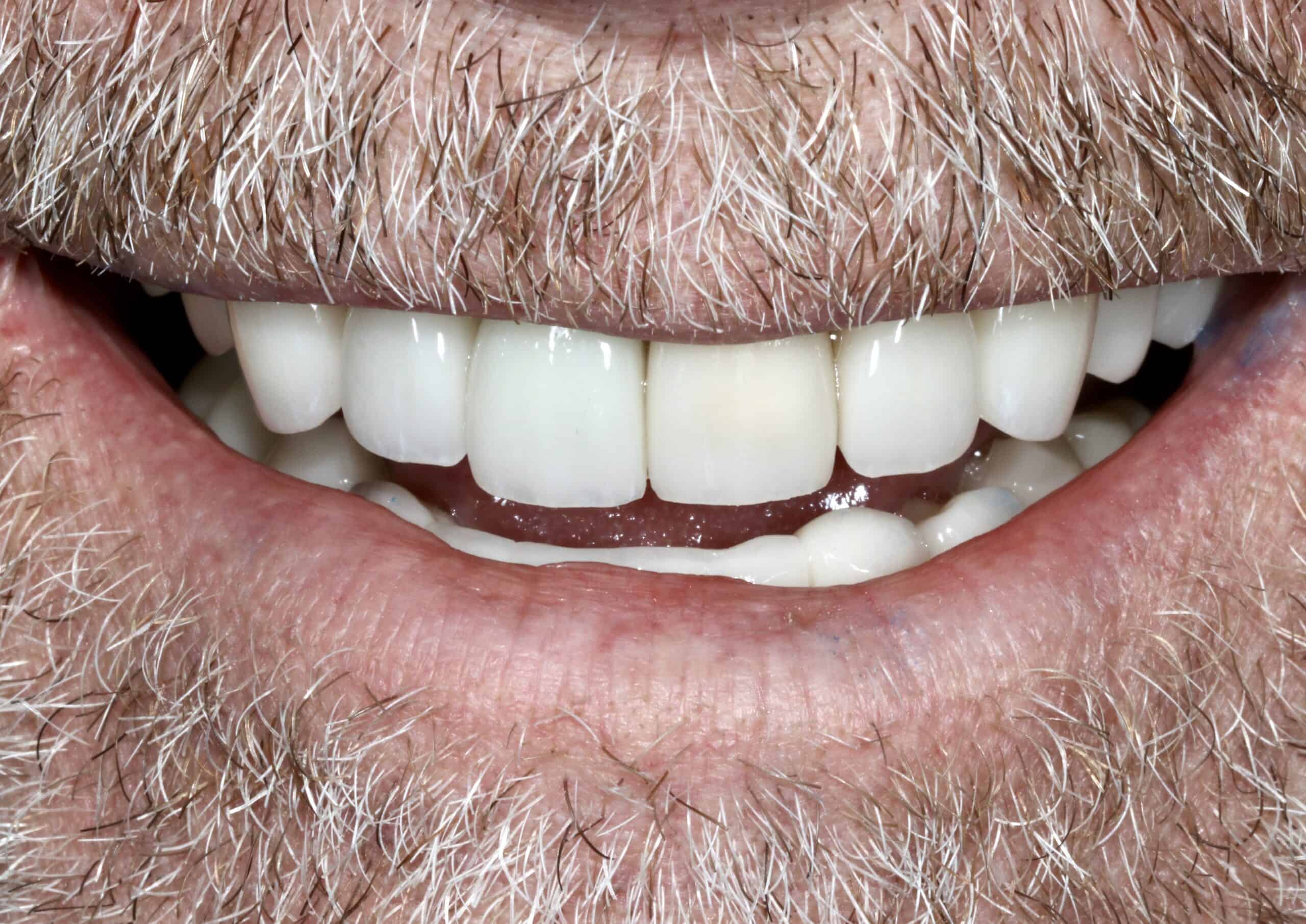 A close-up photo of a patient’s natural-looking smile after receiving prosthodontics treatment at Signature Dentistry of Denver
