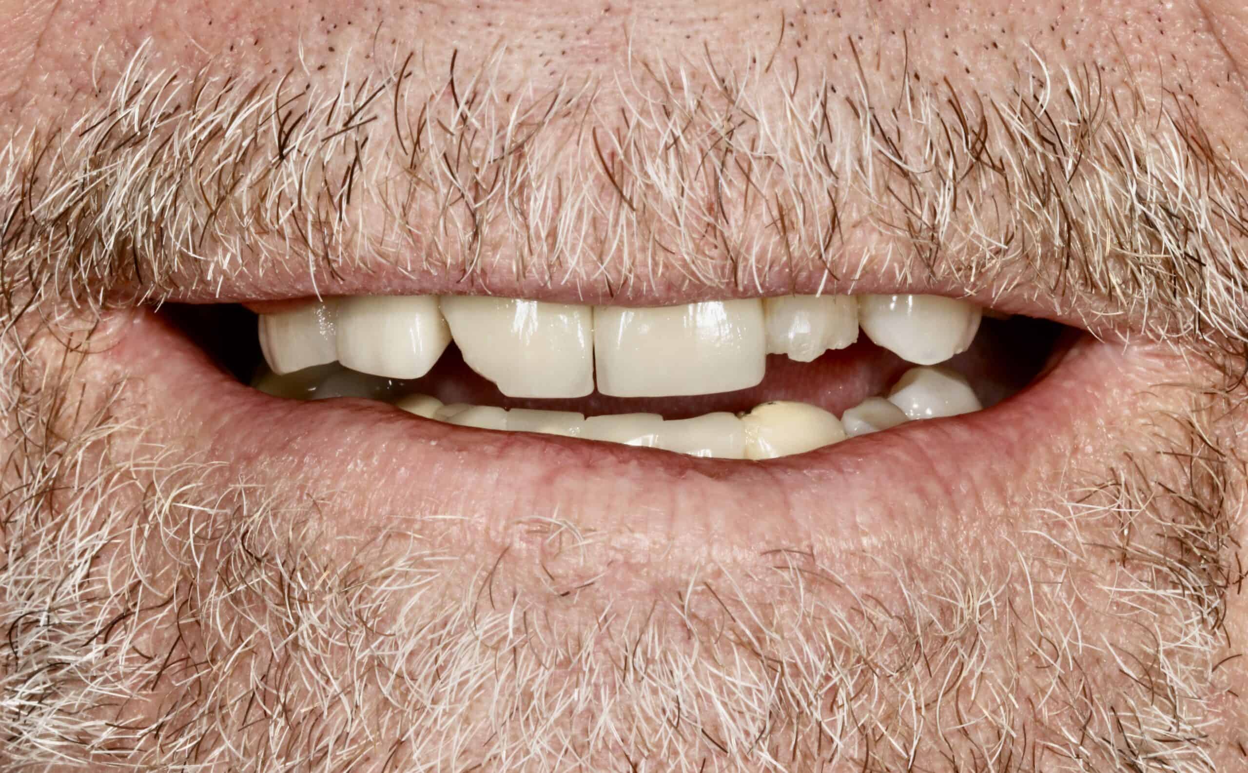 A close-up photo of a patient’s crooked, chipped teeth before receiving treatment at Signature Dentistry of Denver