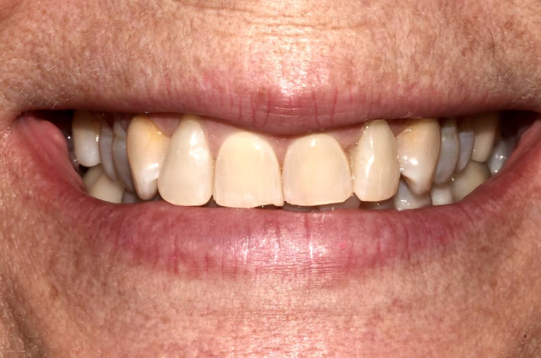 A close-up image of a patient’s discolored, uneven teeth