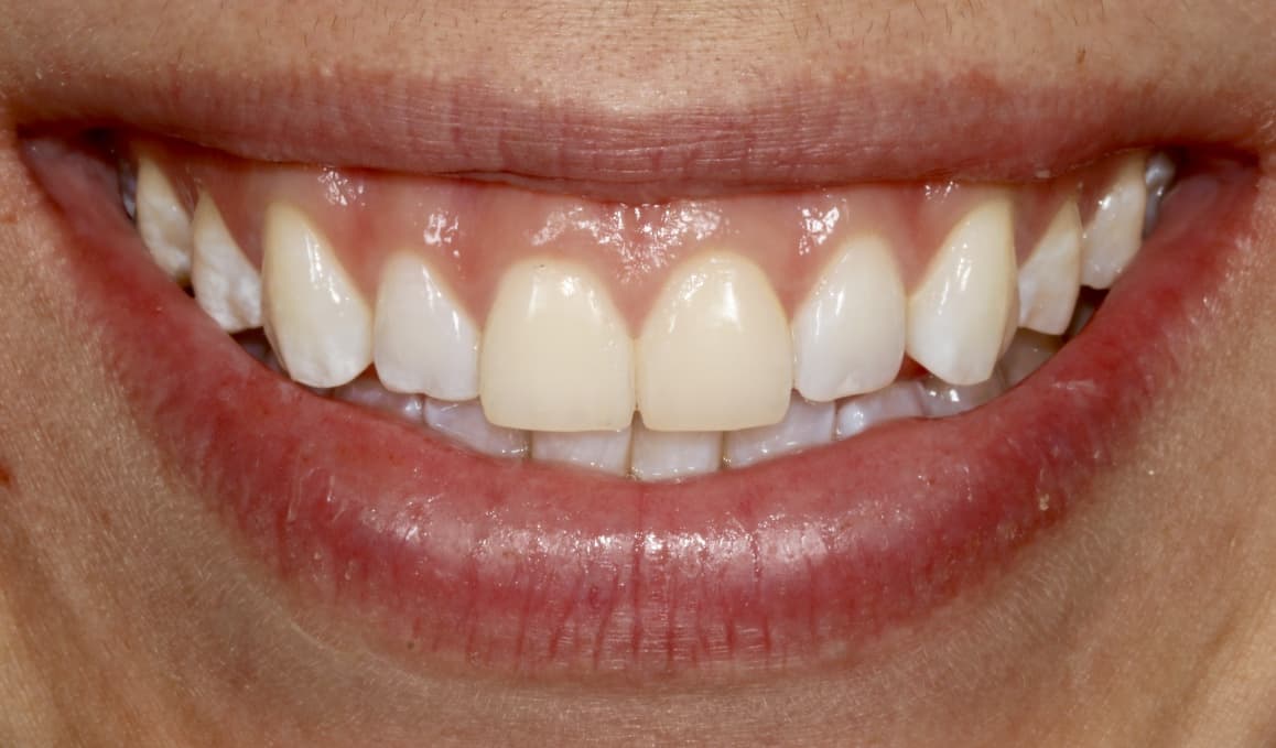 A close-up image of a patient’s tooth discoloration