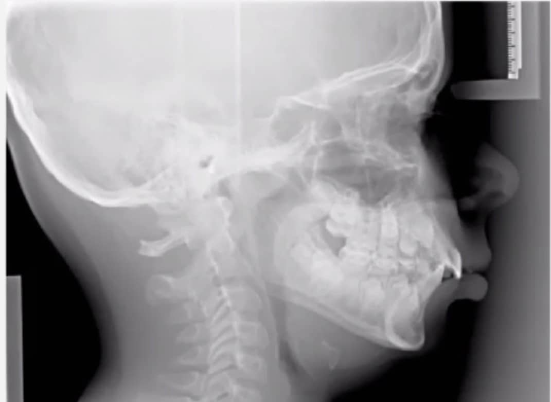 An x-ray image of a child with an underdeveloped airway 