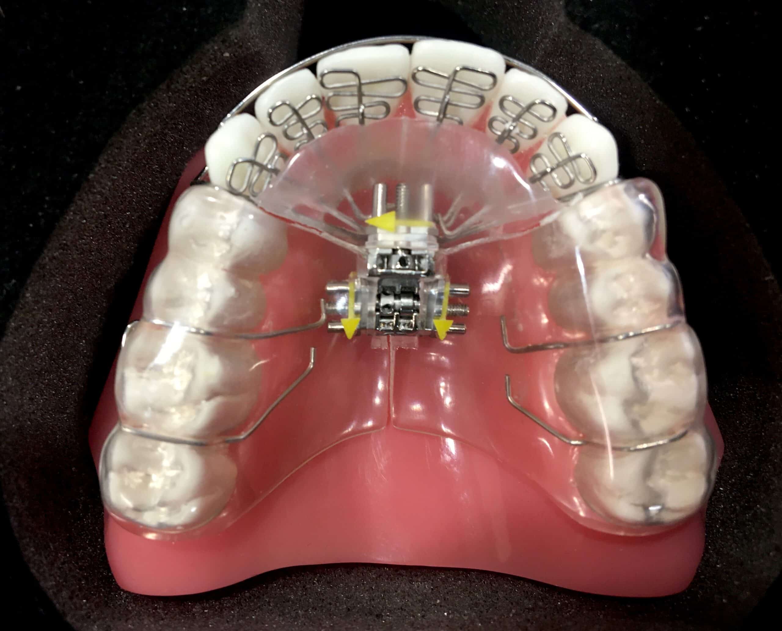 A model of an oral device attached to the roof of the mouth