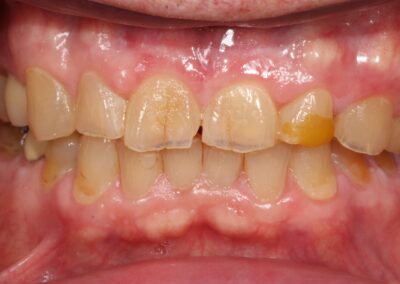 Full Mouth Reconstruction Before Smile