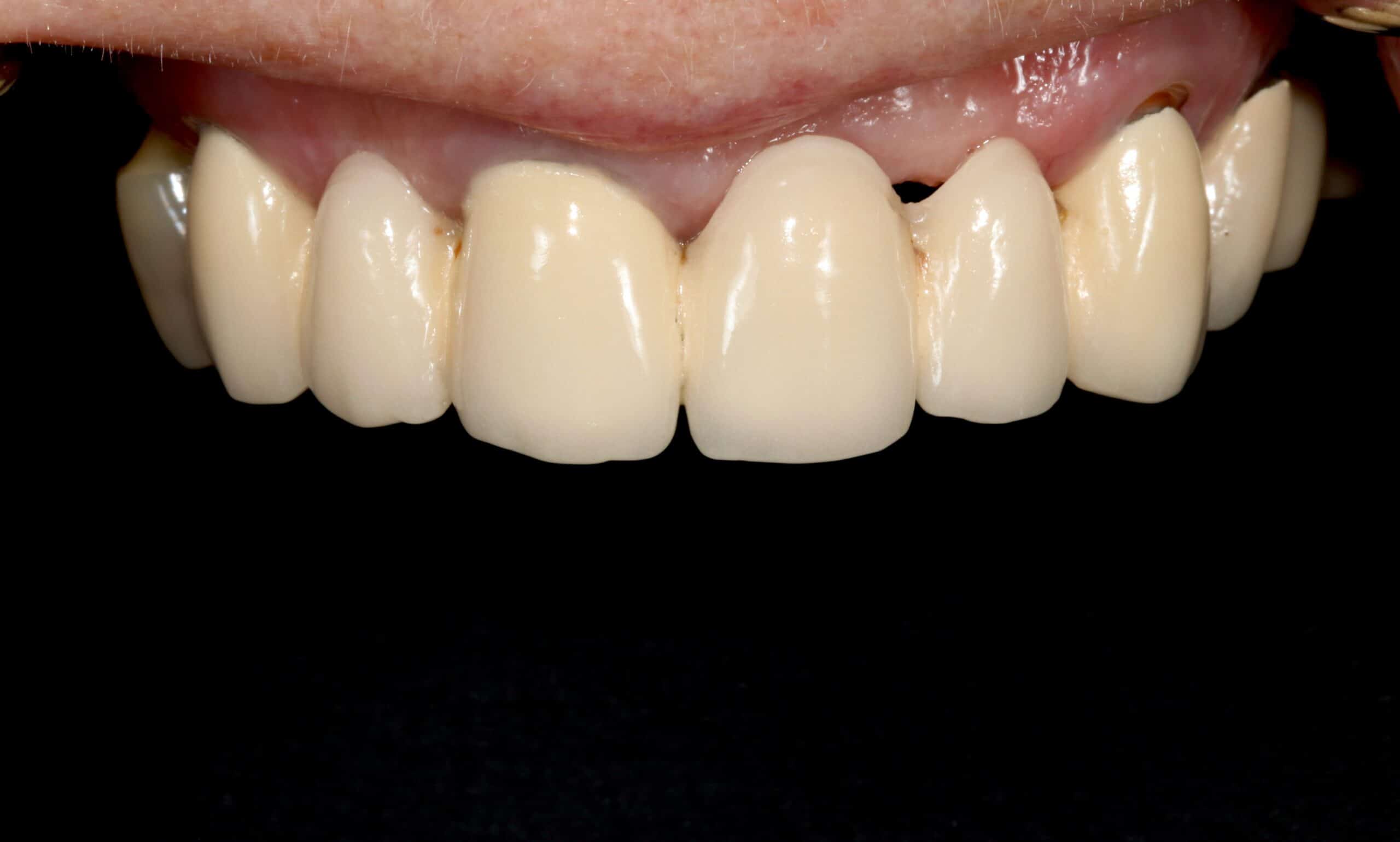 A close-up photo of a patient’s worn teeth and gums before receiving porcelain crowns at Signature Dentistry of Denver