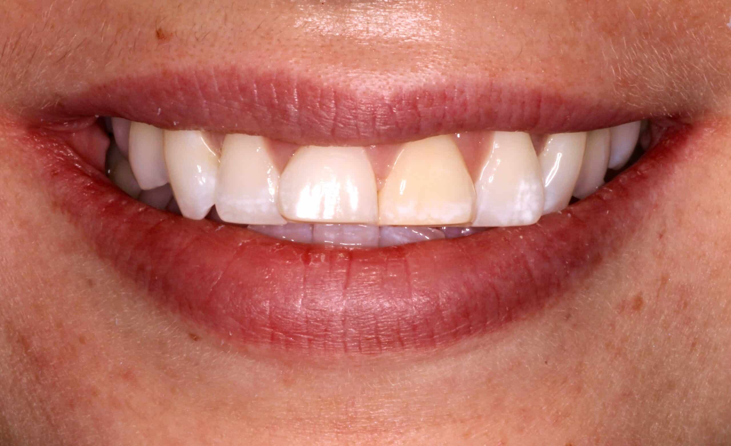 A close-up image of a patient’s crowded, uneven teeth