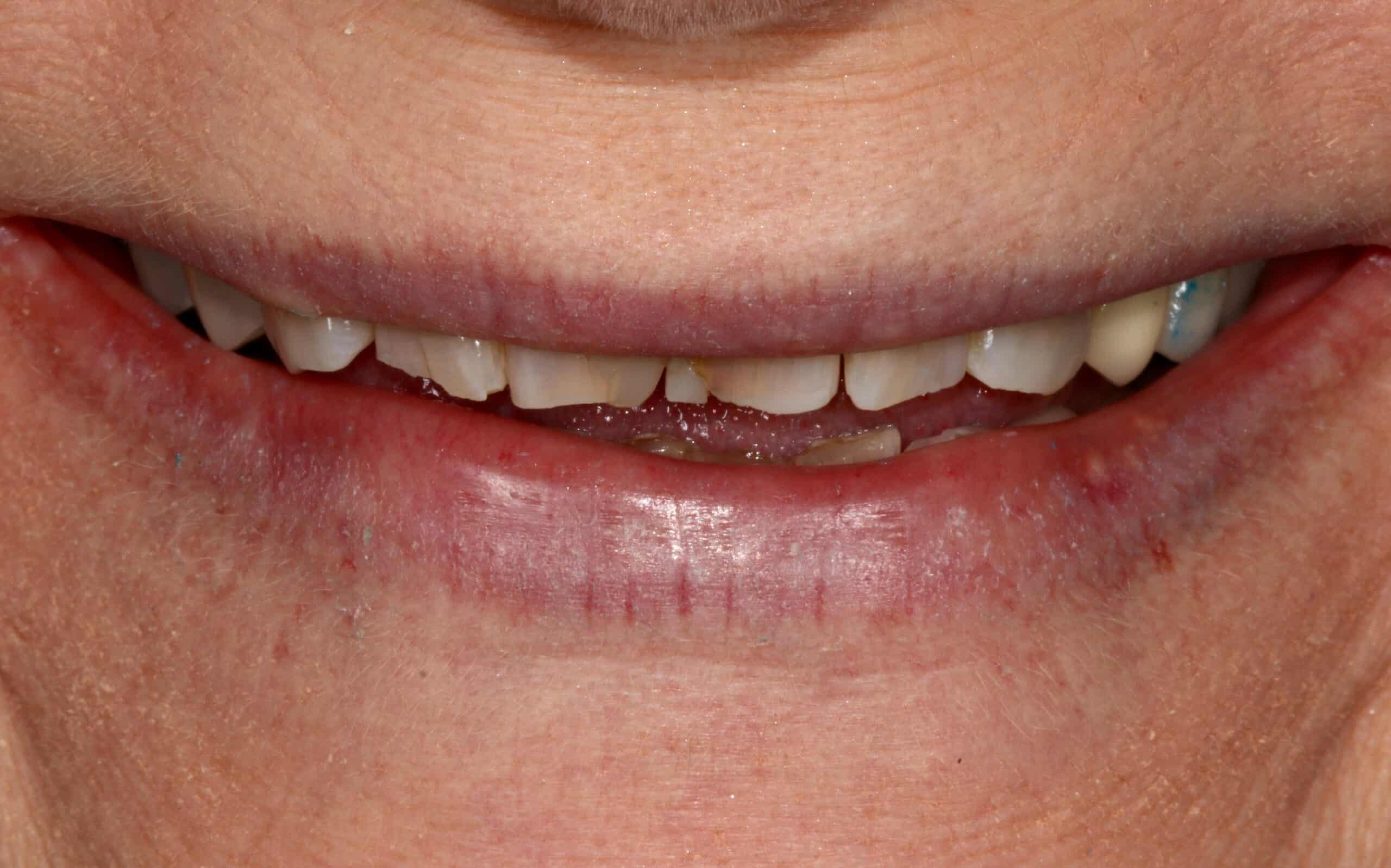 A close-up photo of a patient’s discolored, worn down teeth