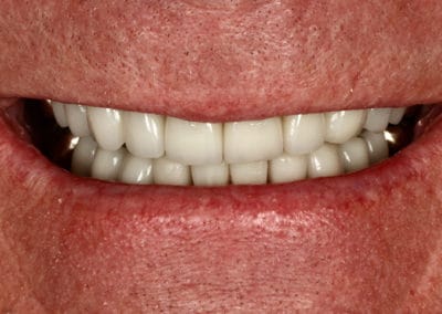 A close up photo of a dental patient's teeth after treatment showing even, healthy-looking teeth