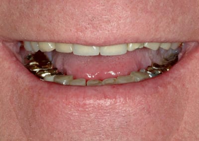 A close up photo of a dental patient's teeth before treatment showing uneven, discolored teeth